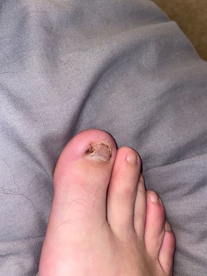 ingrowntoenails OnlyFans picture