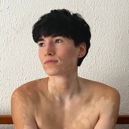 yourvitiligogirl OnlyFans picture
