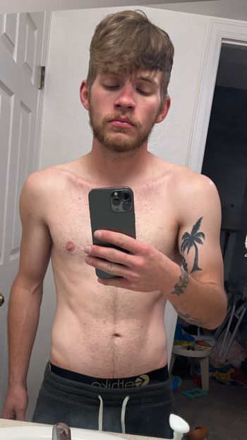 Amputee Anthony