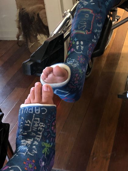 km_casts_crutches OnlyFans picture