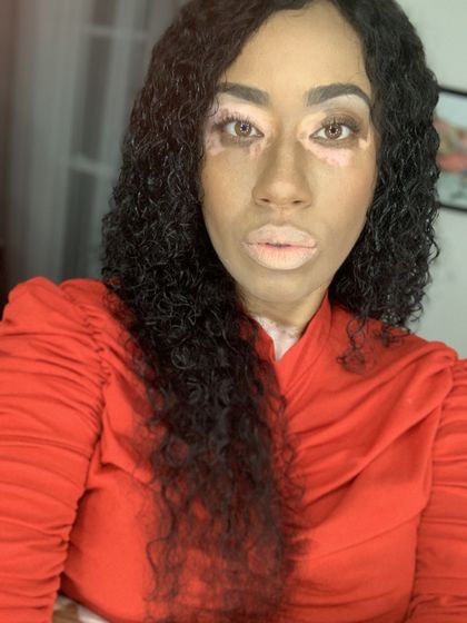 vitiligofox OnlyFans picture