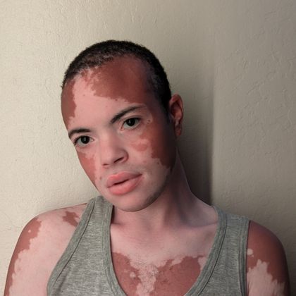 vitiligoftmboi OnlyFans picture